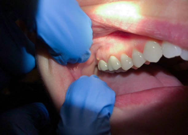 Best Emergency Tooth Extraction  in Willits, CA